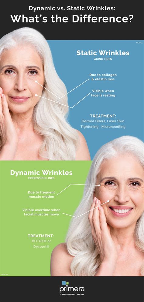 Illustration comparing dynamic and static wrinkles on a face