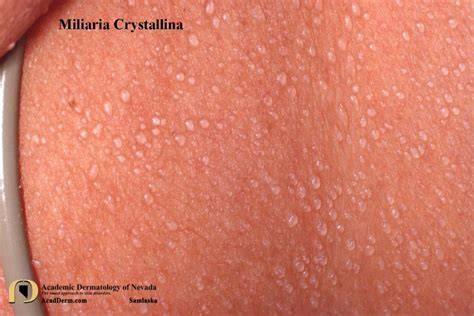 A diagram illustrating the appearance of miliaria rubra and miliaria crystalline on different skin tones.
