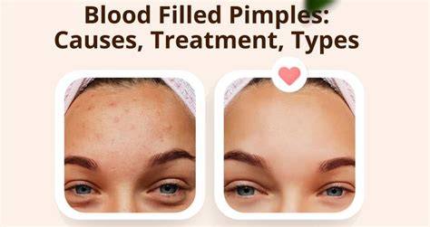 Illustration showing the difference between a regular pimple and a blood pimple, highlighting ruptured blood vessels in the latter.