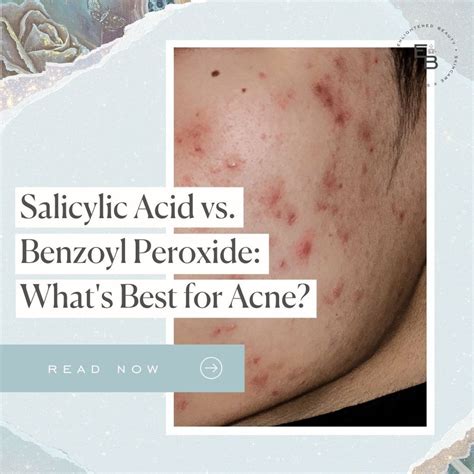 Infographic comparing OTC acne treatments, highlighting benzoyl peroxide and salicylic acid for blood pimples.