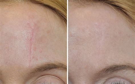 Comparison image showing skin before and after scar treatment (illustrative)