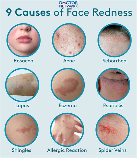 Infographic illustrating common causes of facial redness