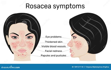 Illustration of rosacea symptoms on the face