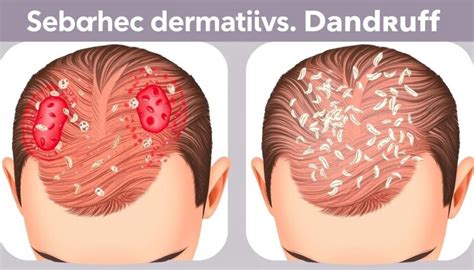 Infographic illustrating the scalp and the effects of dandruff and seborrheic dermatitis.