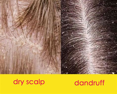 Side-by-side comparison images of dandruff flakes and dry scalp.