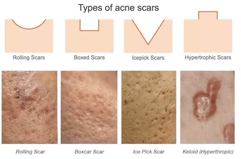 Diagram showing different types of acne scars: icepick, boxcar, rolling, and hyperpigmentation.