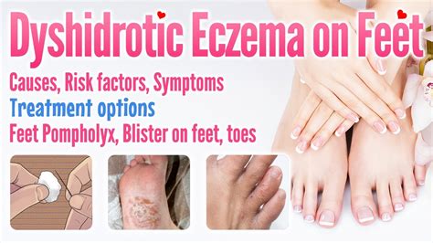 Illustration showing the typical locations of dyshidrotic eczema blisters on the hands and feet.