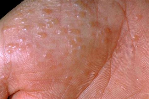 Close-up photograph showcasing the appearance of small, fluid-filled blisters characteristic of dyshidrotic eczema.