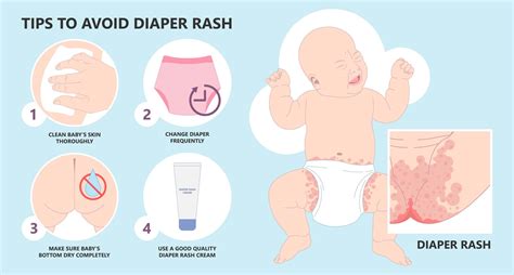 Infographic detailing the steps for proper diaper rash care, including cleaning, drying, and applying barrier cream.