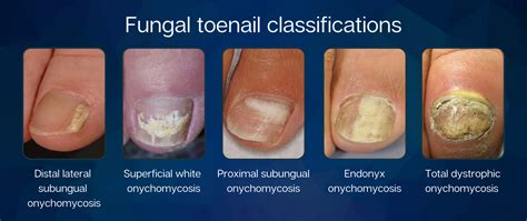 Illustration showing the layers of a toenail and where fungal infections typically occur.