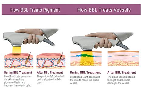 Diagram illustrating the BBL photofacial process, showing light energy penetrating skin layers.