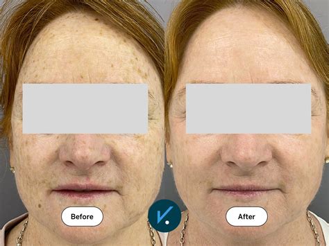 Before and after photos showcasing improvements in skin tone, reduction of sunspots, and smoother texture after BBL treatment.