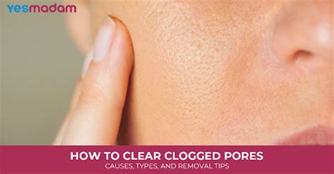 Split image: one side showing clogged pores, the other showing clear skin after using micellar water.