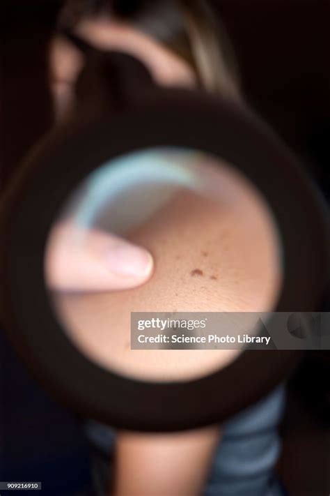 Illustration of a dermatoscope being used to examine a mole