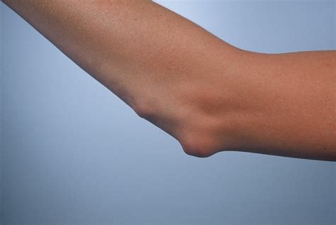 Close-up image of rheumatoid nodules on an elbow.