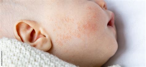 Close-up image of a baby's cheek with mild acne.