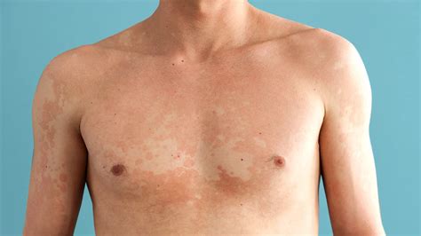 Torso showing patches of tinea versicolor with varying skin tones.