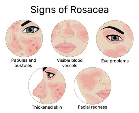 Female face displaying symptoms of rosacea, including redness and bumps.