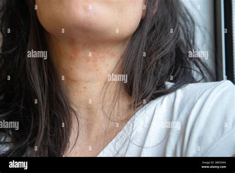 Close-up of a female neck showing signs of an allergic reaction, possibly allergic eczema.