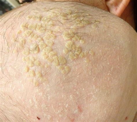 Scalp with seborrheic eczema, showing yellowish, greasy scales.