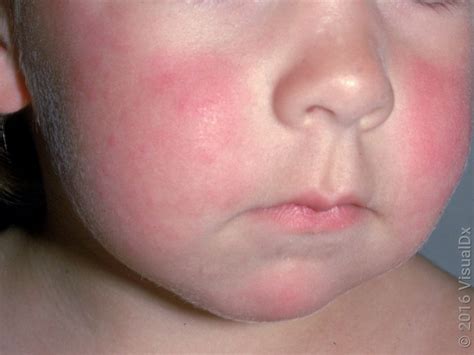 Child's face showing the characteristic 'slapped cheek' rash of Fifth Disease.