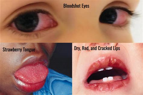 Child with symptoms of Kawasaki disease, including red lips and strawberry tongue.