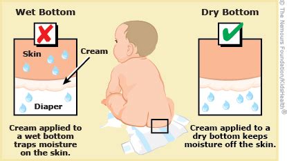 Illustration of diaper rash on a baby's buttocks and thighs.