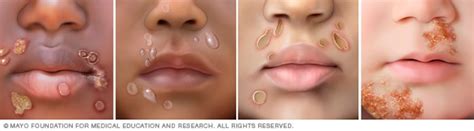 Image depicting impetigo on dark skin, showing characteristic crusting.