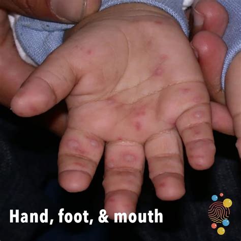 Illustration of hand-foot-and-mouth disease, showing spots on hands, feet, and mouth.