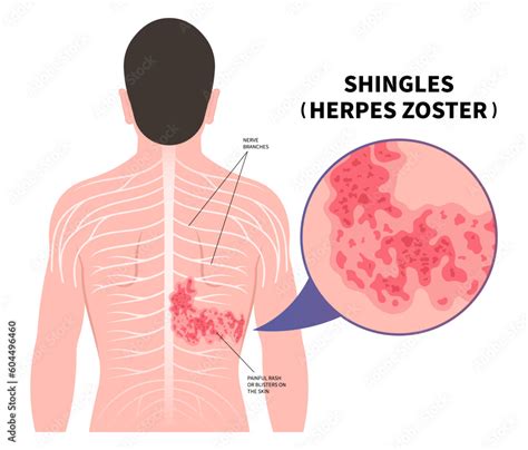 Illustration of shingles rash appearing in a band-like pattern on the torso.