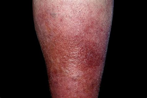 Image showing cellulitis on the leg, with red, swollen, and tender skin.