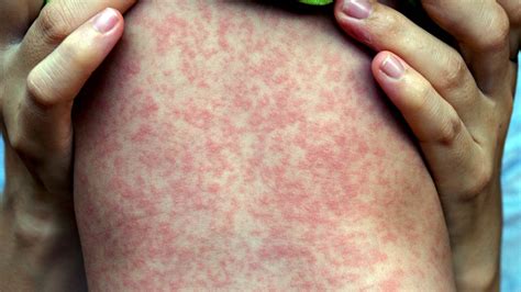 A person showing the characteristic measles rash spreading down the body.