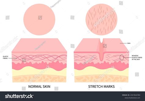 An illustration showing the layers of the skin and where stretch marks form.