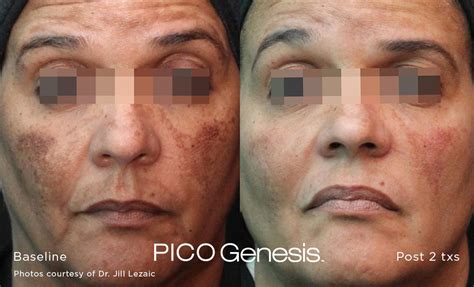 Image illustrating the expected timeline of pigment darkening and exfoliation after Pico Genesis treatment.