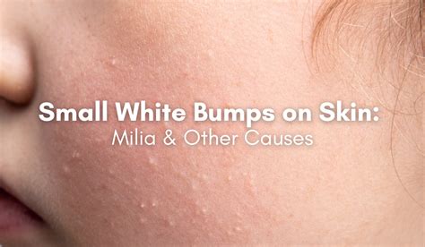 Image displaying small, white bumps (milia) on the skin