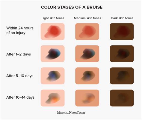 Timeline graphic showing the typical progression of a Botox bruise from initial discoloration to fading