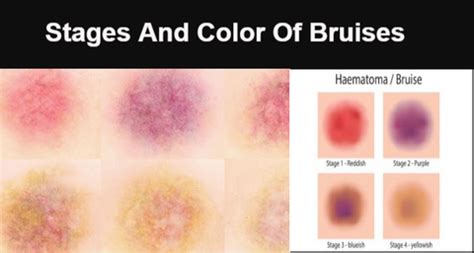 Comparison image showing a typical mild Botox bruise versus a more significant bruise