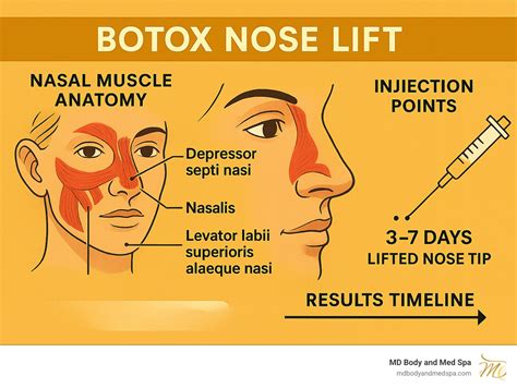 Close-up diagram showing the injection points for Botox in the nasalis muscle.