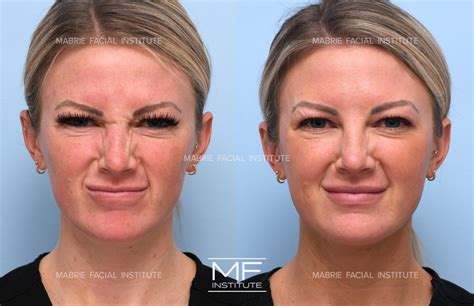 Infographic comparing Botox and other treatments for nose wrinkles.