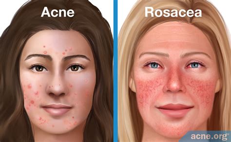 side-by-side comparison graphic of acne and rosacea symptoms