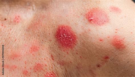 Illustration of a persistent rash on skin with red, inflamed patches.