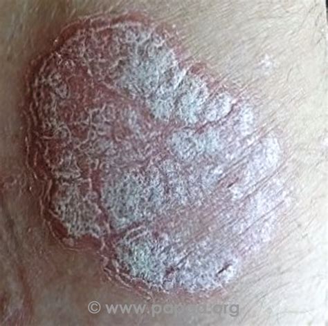 Close-up image of psoriasis plaques with silvery-white scales on red skin.