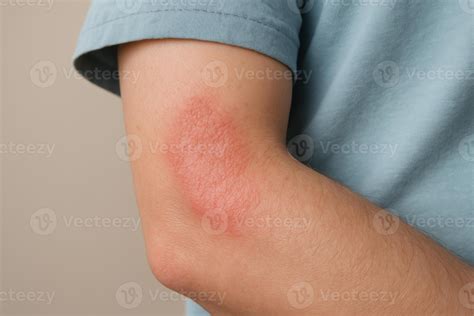 Image showing typical eczema rash on the inner elbow, characterized by redness and dryness.
