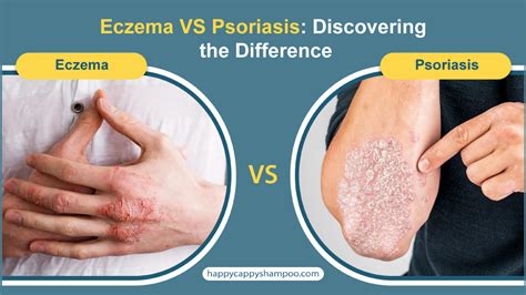Diagram illustrating the differences between eczema, contact dermatitis, and psoriasis.