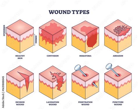 Diagram illustrating different types of wounds suitable for topical skin adhesive application.