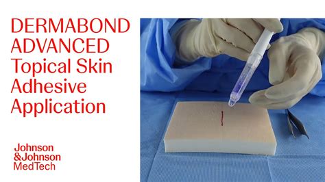 Infographic detailing the steps for applying topical skin adhesive, including wound preparation and layering.