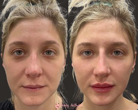 Collage of before-and-after photos showcasing different Restylane treatments: lip enhancement, cheek augmentation, and wrinkle reduction.