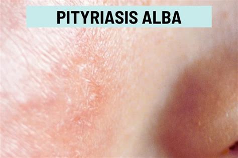 Illustration showing typical round or oval patches of pityriasis alba on the face.