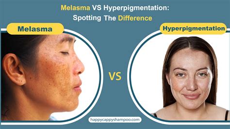 Comparison images showing hyperpigmentation (melasma) and hypopigmentation (vitiligo).