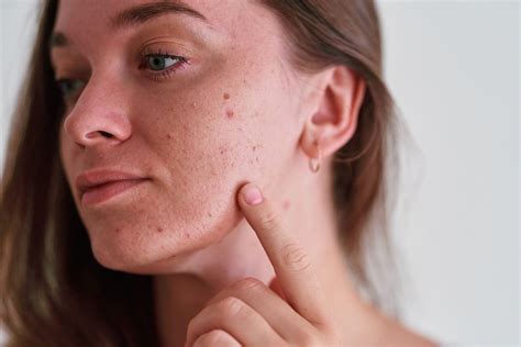 Close-up photo of skin with acne, transitioning to clearer skin